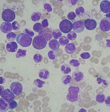 英国赫尔约克医学院发现白血病细胞的遗传倾向